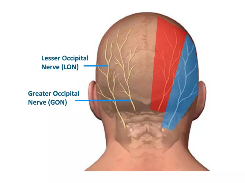Occipital Neuralgia: When Should You See a Pain Specialist?
